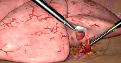 New VR Simulator VATS Lobectomy Study