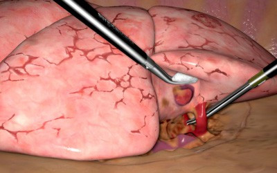 New VR Simulator VATS Lobectomy Study