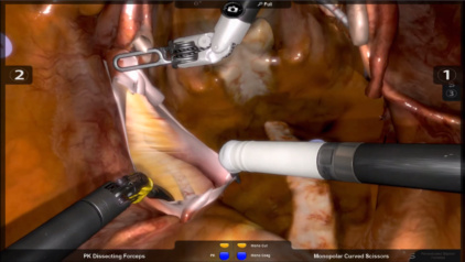 Robotix Mentor Simulator Hysterectomy: Ureter dissection exercise