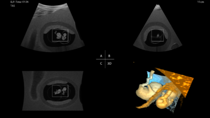 3D Ultrasound - MCDA
