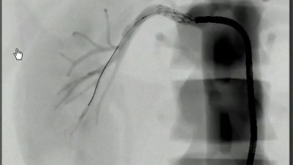 5 final angiography