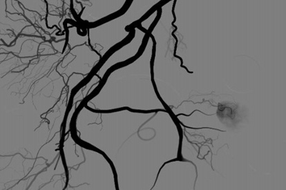Prostatic Artery Embolization Module