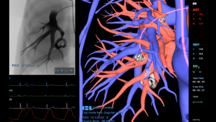 Pulmonary-arteriovenous-malformation-Embolization-3D
