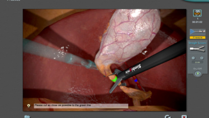 A laparoscopic cholecystectomy exercise on a simbionix simulator