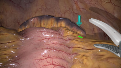 A gastrectomy exercise on a Simbionix laparoscopy simulator