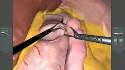 Gastric Bypass exercise on LAP Mentor simulator
