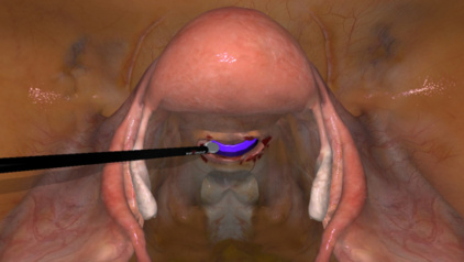 A hysterectomy exercise on a Simbionix simulator