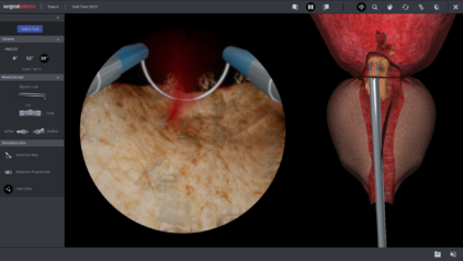 Median lobe resection