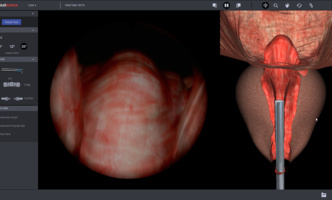 New TURP Modules for URO Mentor Simulator