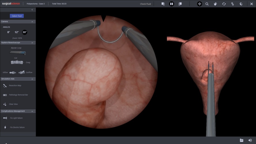 Hysteroscopic Polypectomy - Surgical Science