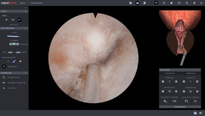 Adenoma separation