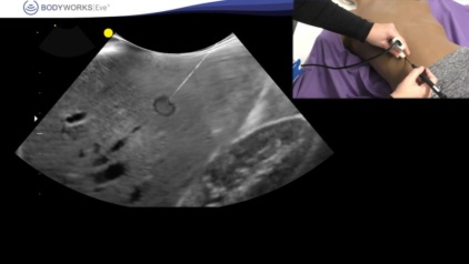 Needling on Eve_Tamponade