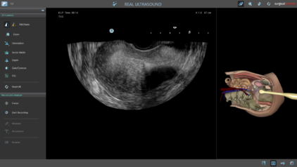 Ultrasound Mentor - Adenomyosis with an IUCD