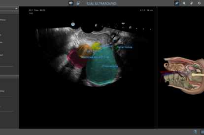 Endometriosis Module