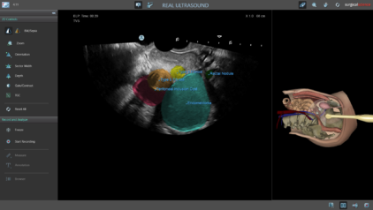 Ultrasound Mentor - Endometrioma and Posterior Uterine Fibroids with labels