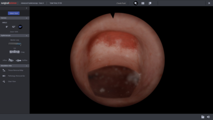 Isthmocele