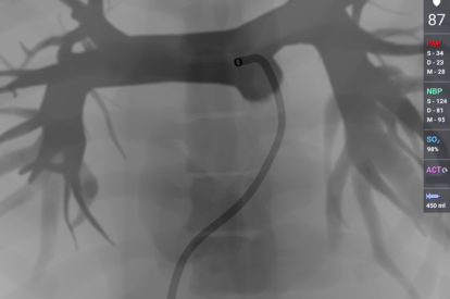 Pulmonary Thrombectomy module