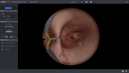 Septate Uterus