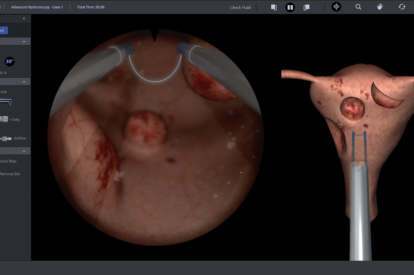 Advanced Hysteroscopy