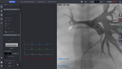 Pulmonary Embolism