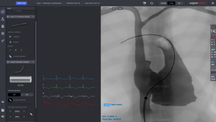 Saddle Embolism